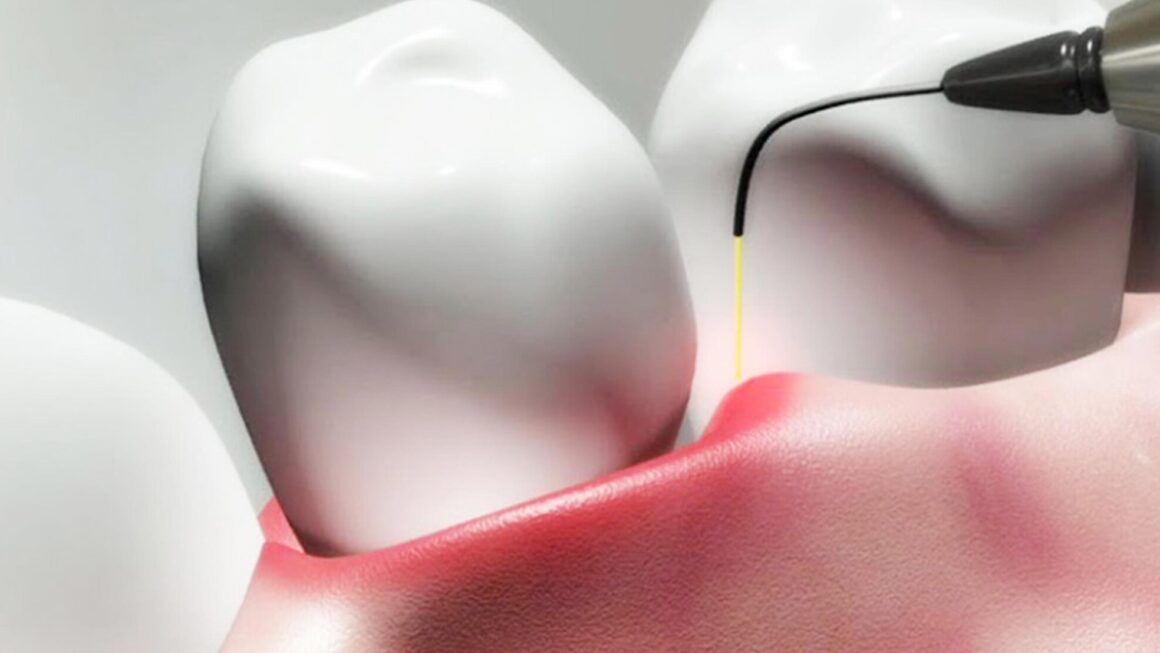 The use of diode lasers in dentistry: benefits and applications
